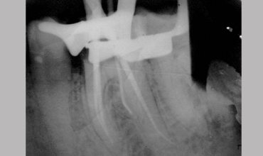 Dentures treatment in Anand                        